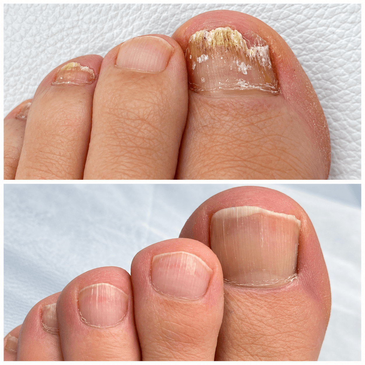 16. tratamiento de hongos en las uñas ​ dra olga correa medicina estética en cartagena